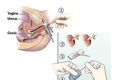 tct和hpv有什么区别,都要检查吗?，tct和hpv有什么区别多少钱