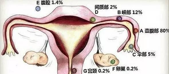 宫外孕的早期症状有哪些特点，宫外孕的初期症状是什么