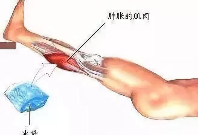 运动剧烈造成肌肉拉伤应该怎么办，剧烈运动后肌肉拉伤怎么办