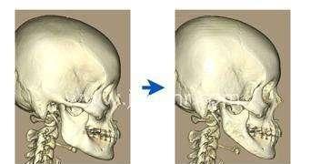 如何让下颌骨变小不反弹，如何让下颌骨变小自然方法