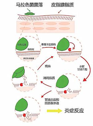 头皮屑多是什么原因