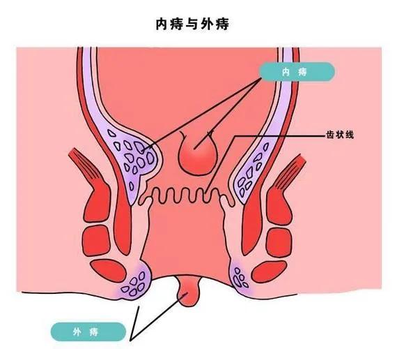 什么是痔疮