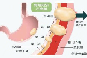 印戒细胞癌在胃的哪里